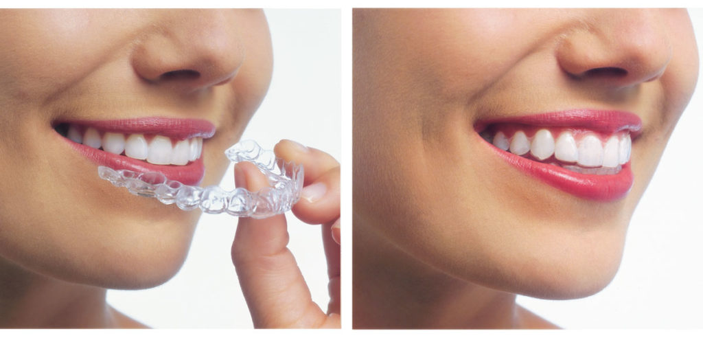 invisalign aligners at Smiles Dental