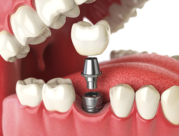 dental implants icon demonstration