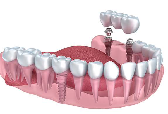 dental-bridges at Smiles Dental