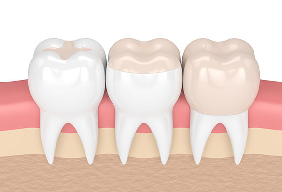 dental layout, filling at Smiles Dental, Composite Dental Fillings