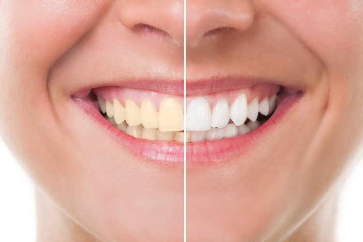 teeth whitening before and after comparison