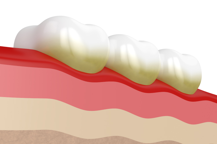 Artistic rendering of the gum line and three teeth with yellowish tartar and calcium deposits