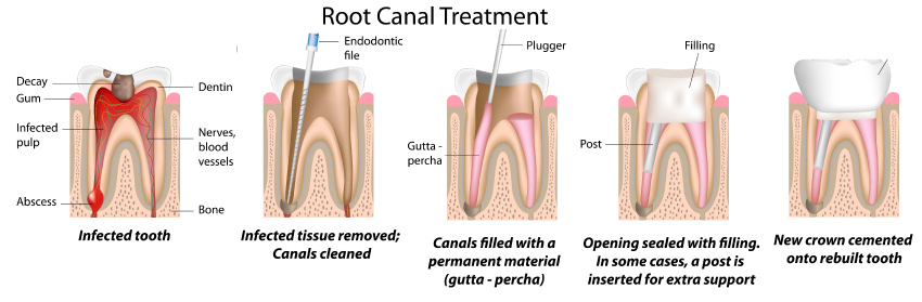 Visual showing the steps to root canal therapy