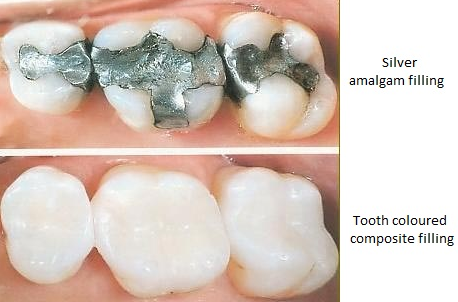 A photo of mercury filled amalgam fillings on the top and tooth colored composite fillings on the bottom