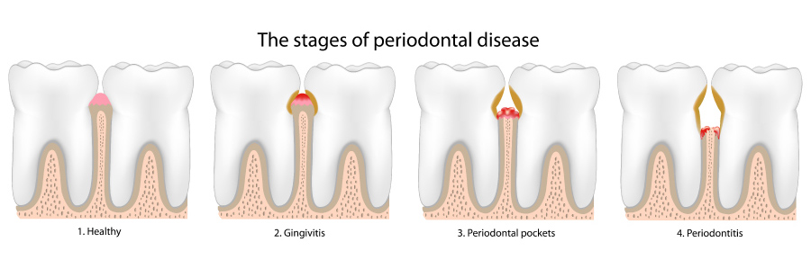 Graphic showing the stages of periodontal or gum disease.